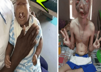 😭Very Sad: The Most UNUSUAL People With Rarest Mutation